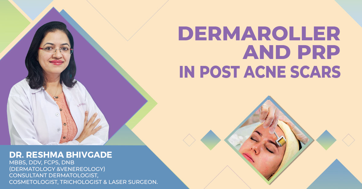 Dermaroller and PRP in Post Acne Scars - Kshipra Health Solutions