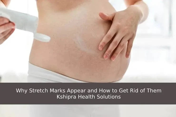 Why Stretch Marks Appear and How to Get Rid of Them